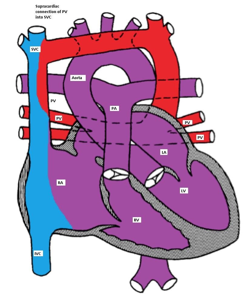 Supracardiac type TAPVC